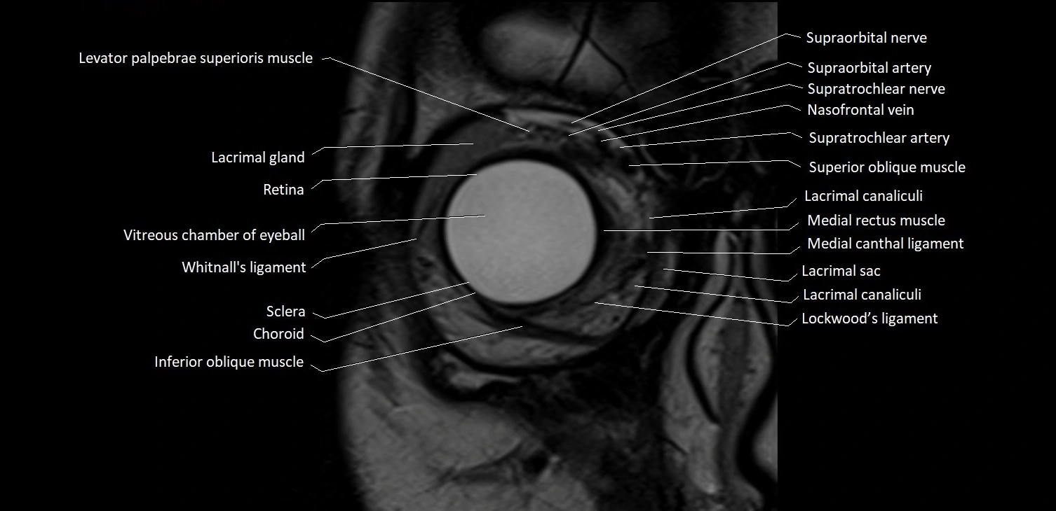 MRI Orbit coronal cross sectional anatomy image 4.webp